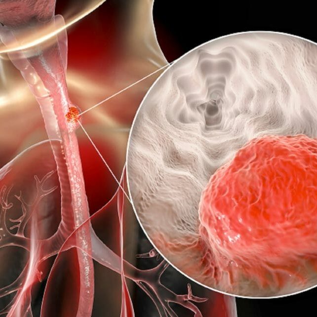 Esophageal Cancer Awareness - Premier Oncology Consultant - Premier Oncology Consultant