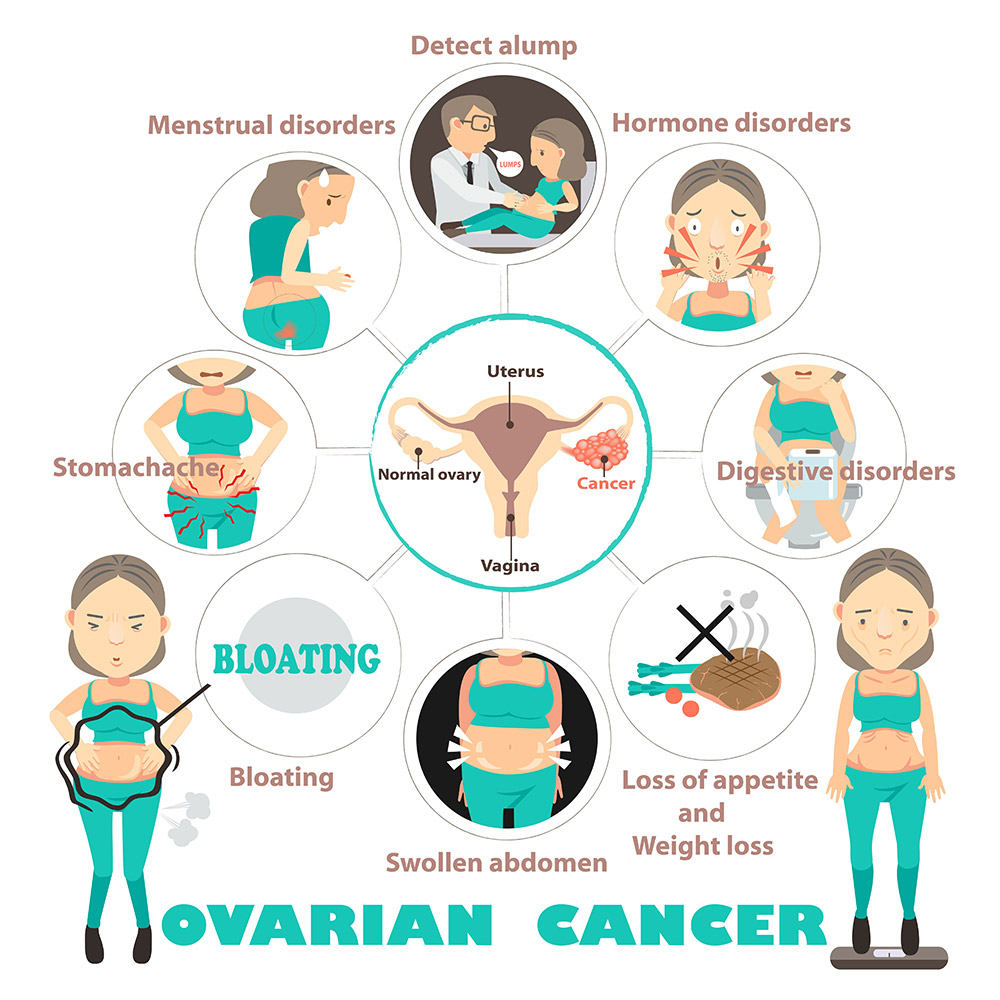 Signs & Symptoms of Ovarian Cancer | Premier Oncology