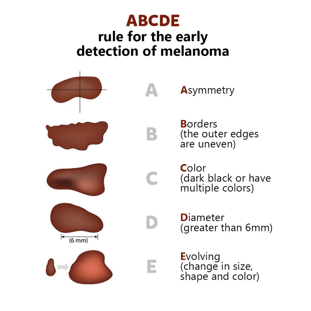 signs-skin-cancer-premier-oncology-houston-katy-texas