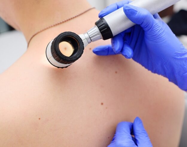 What is Melanoma