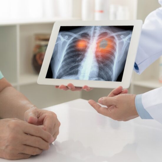 Lung cancer