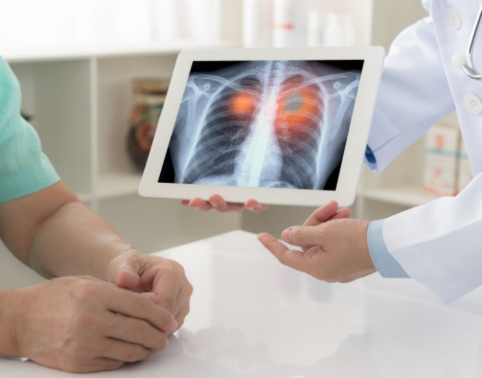 Lung cancer