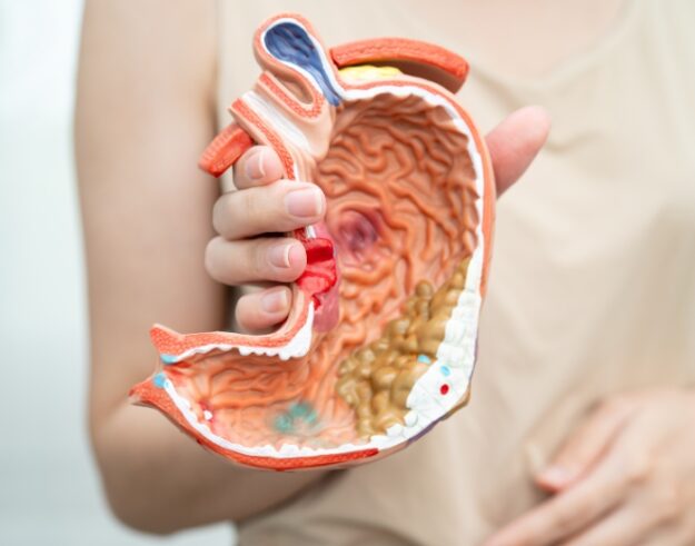 Symptoms of Bowel Cancer in a Woman | Early Warning Signs Guide