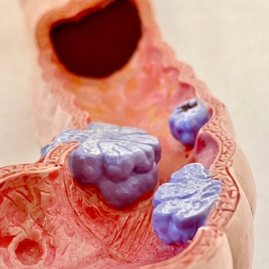 colon cancer warning signs What Are the Symptoms of Colon Cancer? | Early Warning Signs Guide