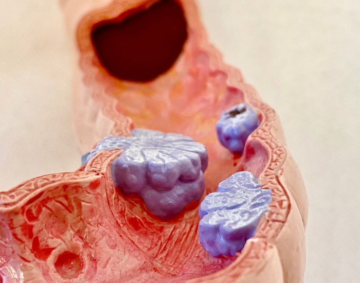 colon cancer warning signs What Are the Symptoms of Colon Cancer? | Early Warning Signs Guide