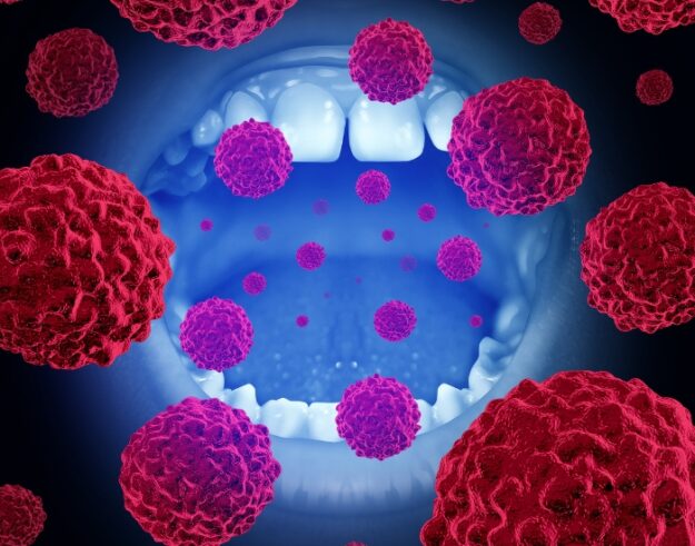 What Does Mouth Cancer Look Like? | Early Visual Signs Explained