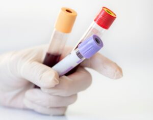 high WBC leukemia