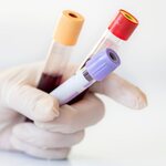 high WBC leukemia