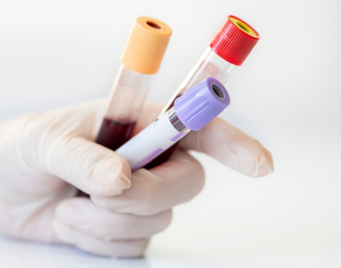 high WBC leukemia